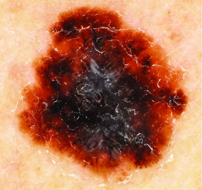 Fig. 3: Dermatoscopic Image